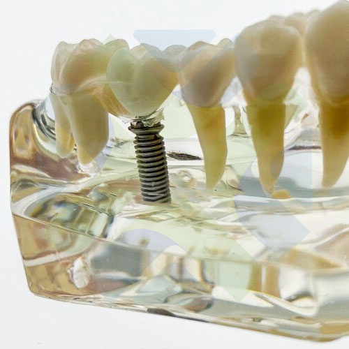 MODELO DE IMPLANTE CON PUENTE INFERIOR Modelos De Implantes Dentales