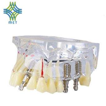 MODELO DE IMPLANTE CON PUENTE Y CARIES Modelos De Implantes Dentales