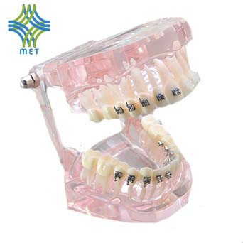 MODELO DE ORTODONCIA CON BRACKETS CERÁMICOS - Modelos de Ortodoncia Dentales